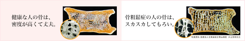 健康な人の骨は、密度が高くて丈夫。骨粗鬆症の人の骨は、スカスカしてもろい。